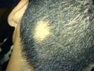Alopecía o pérdida del cabello